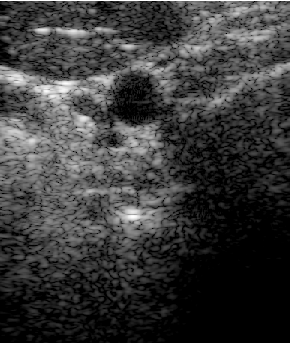 Preview for PICMUS_carotid_cross.uff