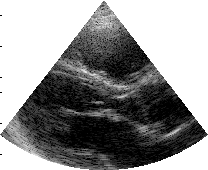 Preview for Verasonics_P2-4_parasternal_long_small.uff